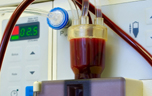 Dialysis developed for kidney failure