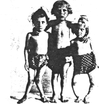 Figure 2. Children of 6 years of age with severe rachitic deformities compared with a normally grown child of the same age. Vienna 1920.