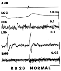 Figure 3. Polygraphic traces of records made in a normal cat during non-REM. The tracing, resulting from electrical activity in the lateral geniculate body (LGN) exhibits both a spontaneous and a sound incuced (90 dB, 500 Hz, 100 msec pure tone burst) PGO wave. A slight body twitch, or startle, occured following the sound as seen in the EMG record. A very subtle non-EEG change also occurred but then the cat continued in non-REM. Time calibration = 1 second. Reproduced with permission from Acta Neurobiologiae Experimentalis from Morrison and Bowker (1975).