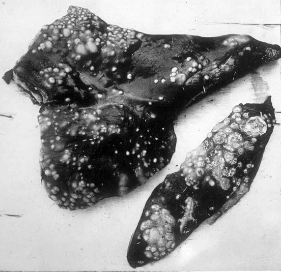 tuberculosis in liver