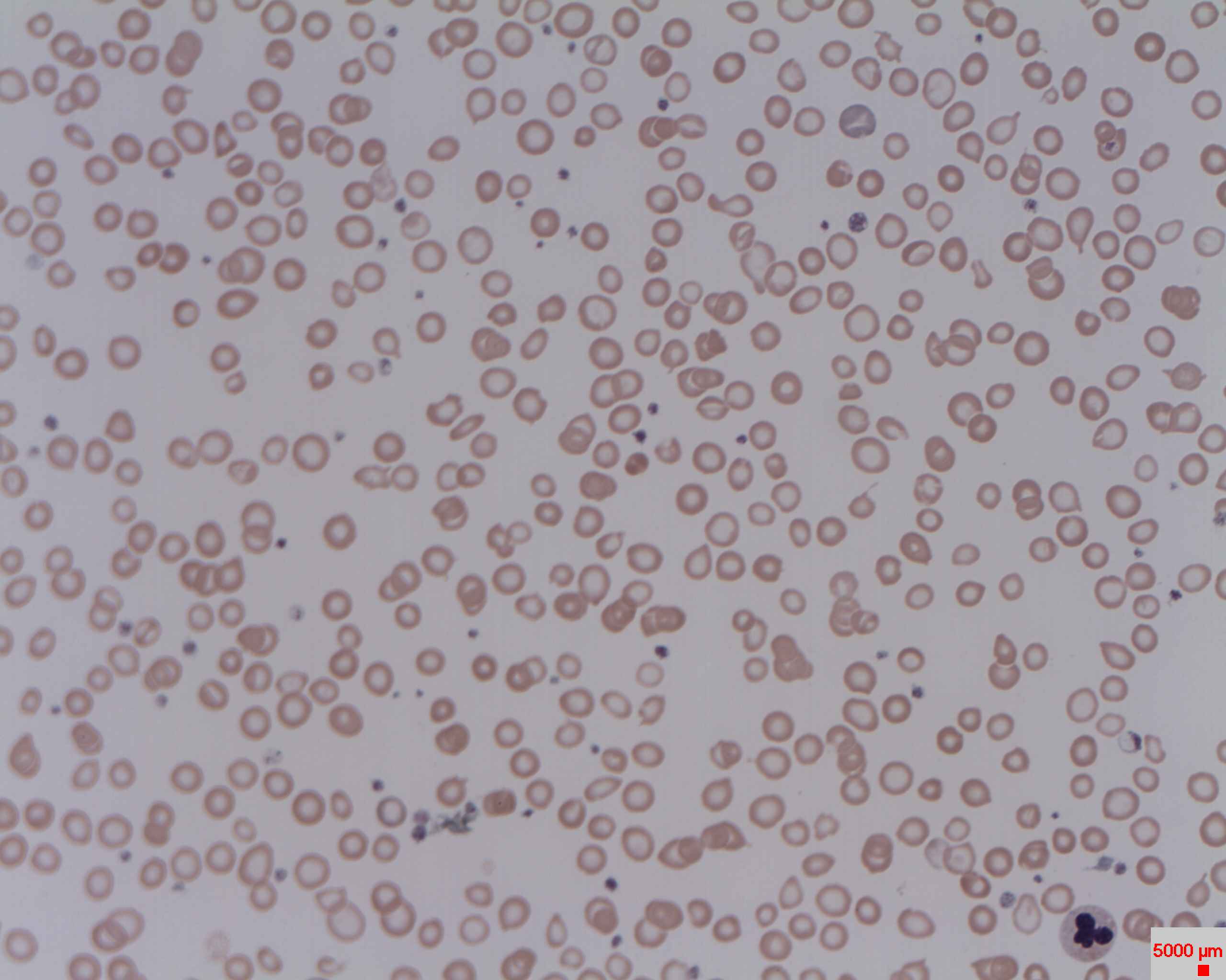 Iron deficiency anaemia is a condition where a lack of iron in the body leads to a reduction in the number of red blood cells. It is associated with a microcytic and hypochromic red cell picture.By Erhabor Osaro (Associate Professor) (Own work) [CC-BY-SA-