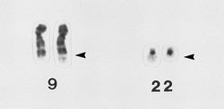 Comparado con la versión sana de cada cromosoma en la izquierda, se ve claramente que un fragmento del cromosoma 22 es transferido al cromosoma 9. Esto se conoce como cromosoma Filadelfia y puede desencadenar leucemia.