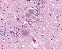 Brain tissue with typical amyloid plaques found in a case of vCJD. 