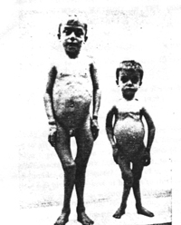 Figure 1. Two brothers with rickets
