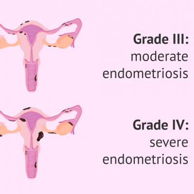 types-of-endometriosis.png