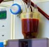 Entwicklung der Dialyse für Nierenversagen
