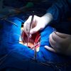 Erfolgreiche Herztransplantationen beim Menschen