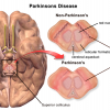 Parkinson's Disease